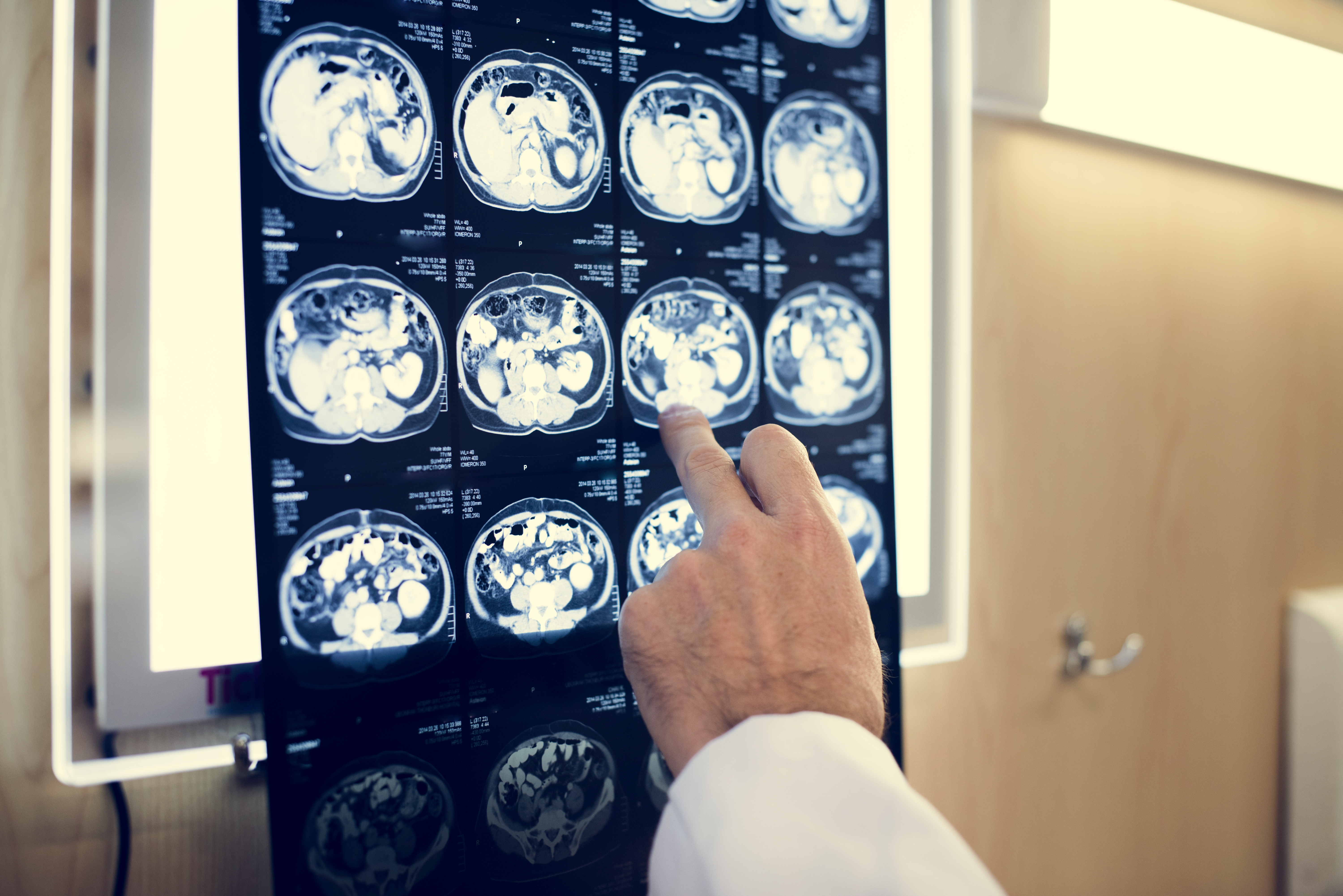 Brain MRI on a light box with hand pointing at one of the images
